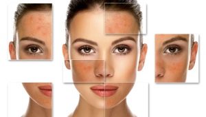 Peeling salicylique: caractéristiques et règles d'application