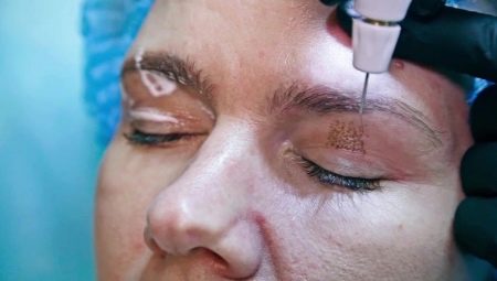 Blépharoplastie plasmatique: de quoi s'agit-il?