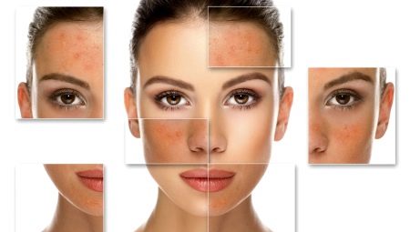 Peeling salicylique: caractéristiques et règles d'application