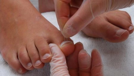 Ongles grandissent: causes et méthodes de traitement