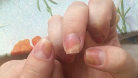 Onycholyse après application d'un gel lustrant