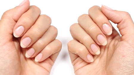 Ongles en couches: causes, traitement et prévention
