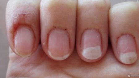 Allergie au gel: causes, symptômes et méthodes de traitement