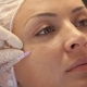 Mésothérapie faciale: de quoi s'agit-il et comment est-il effectué?