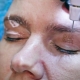 Blépharoplastie plasmatique: de quoi s'agit-il?