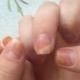 Onycholyse après application d'un gel lustrant