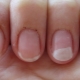 Allergie au gel: causes, symptômes et méthodes de traitement